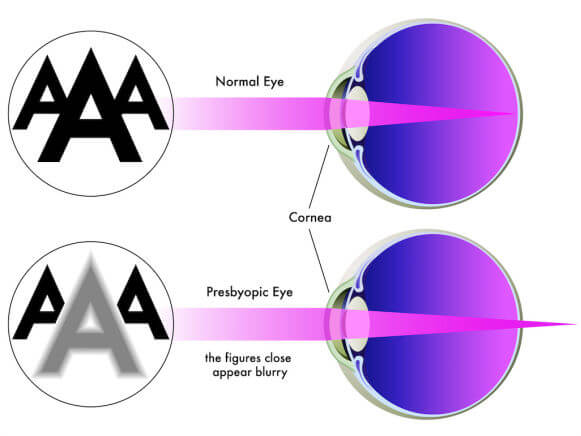 post-goodbyeglasses2